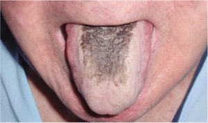 black tongue